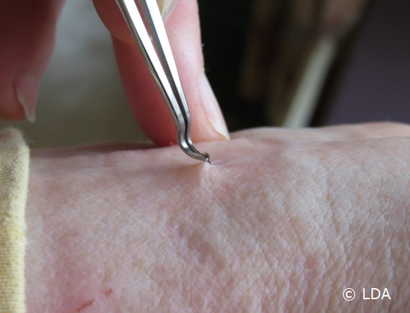 how to get rid of a tick without tweezers